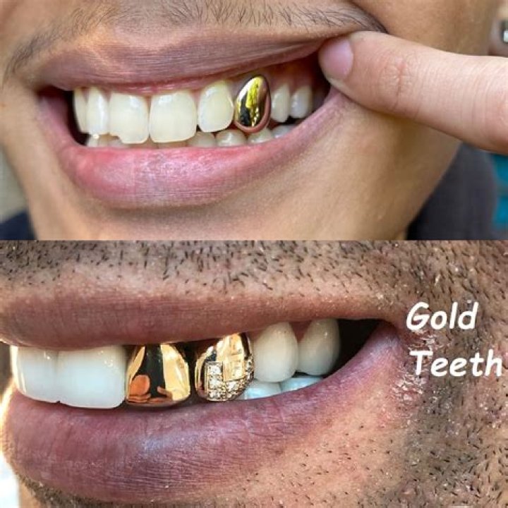 Do dentist do gold teeth?