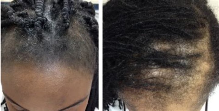 Do dreadlocks cause traction alopecia?
