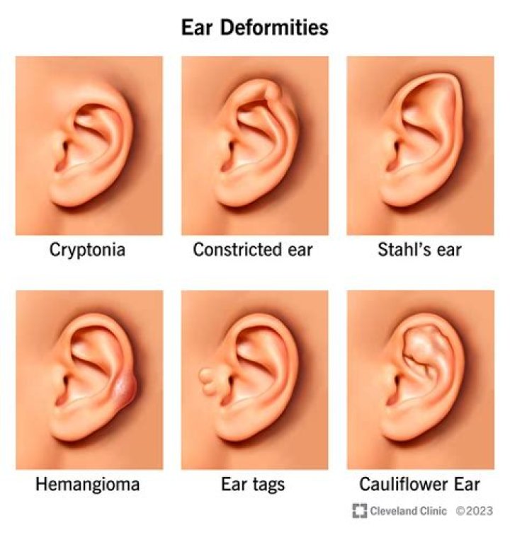 Do ear lobes change shape with age?