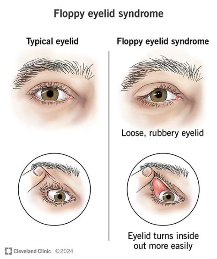 Do eyelids droop as you get older?