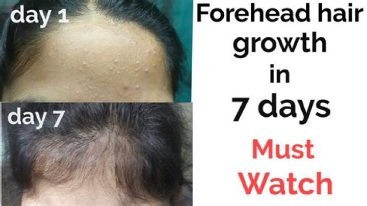Do foreheads grow with age?
