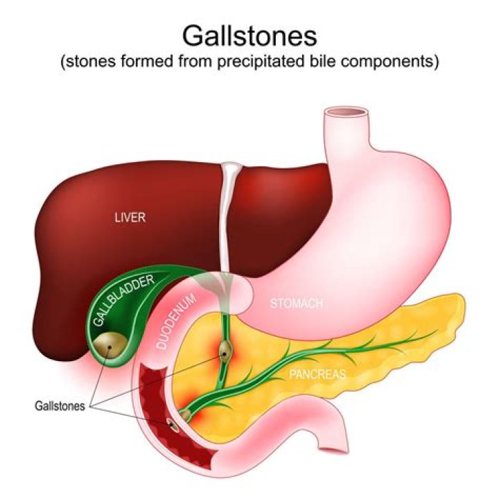 Do I need gallbladder surgery if I have gallstones?