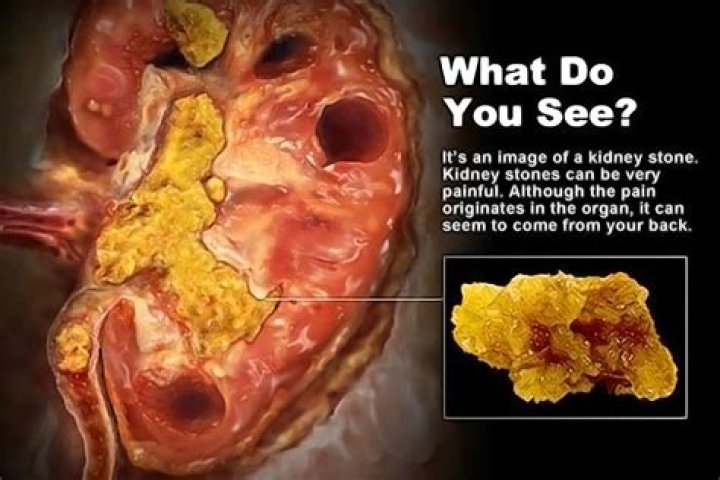 Do Japanese get kidney stones?