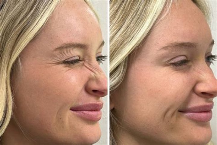 Do lines or shading hurt more?