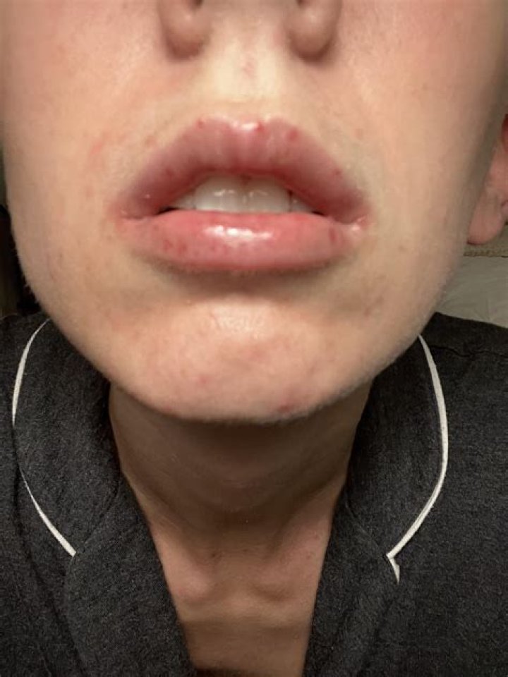 Do lips bleed a lot?
