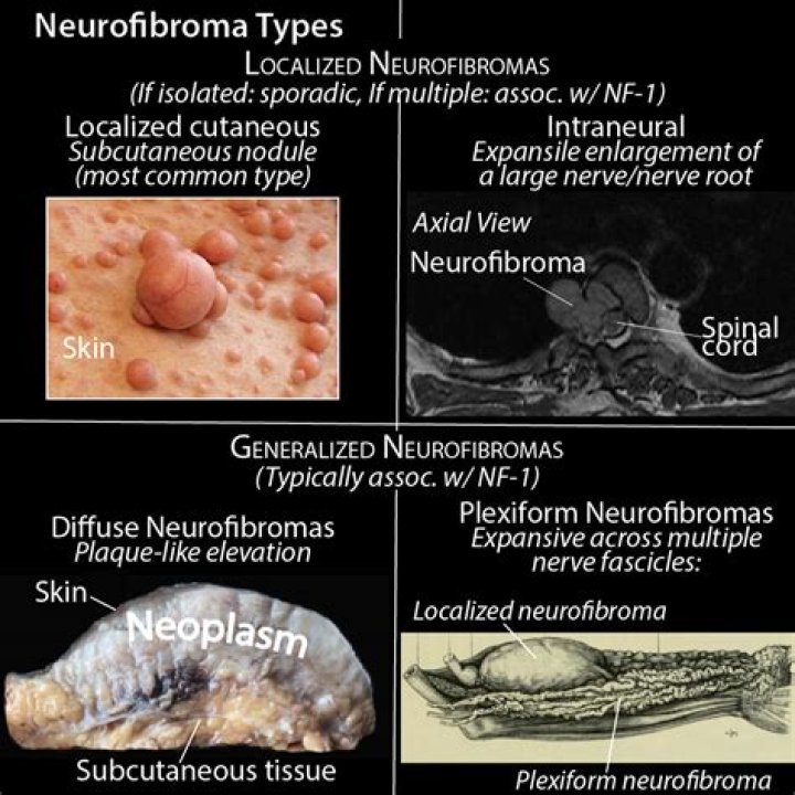 Do neurofibromas look like pimples?