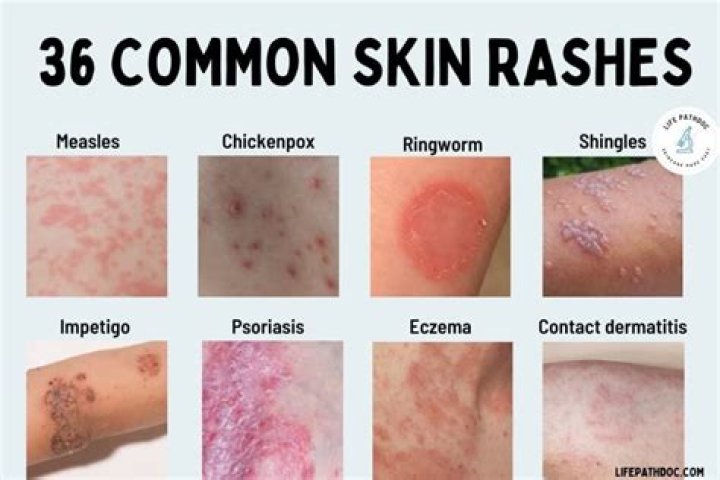 Do rashes go away overnight?