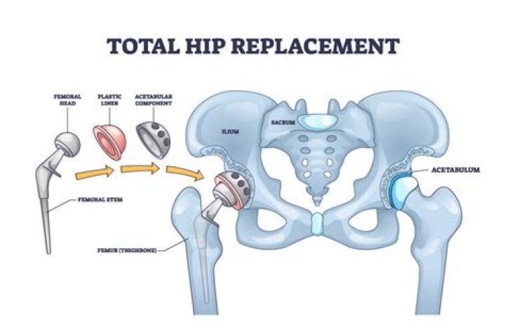 Do runners have more hip replacements?