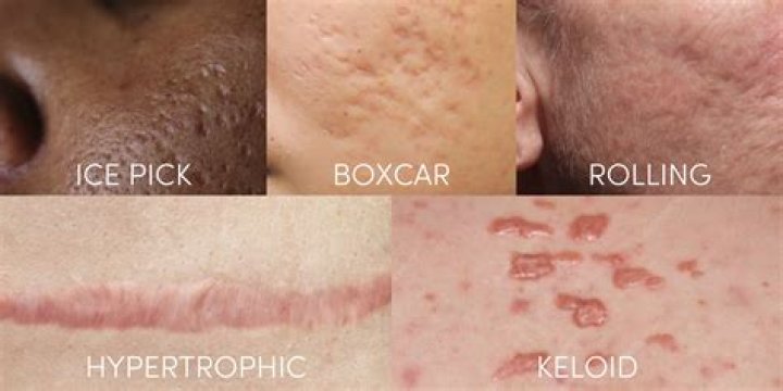 Do scars look worse as you age?