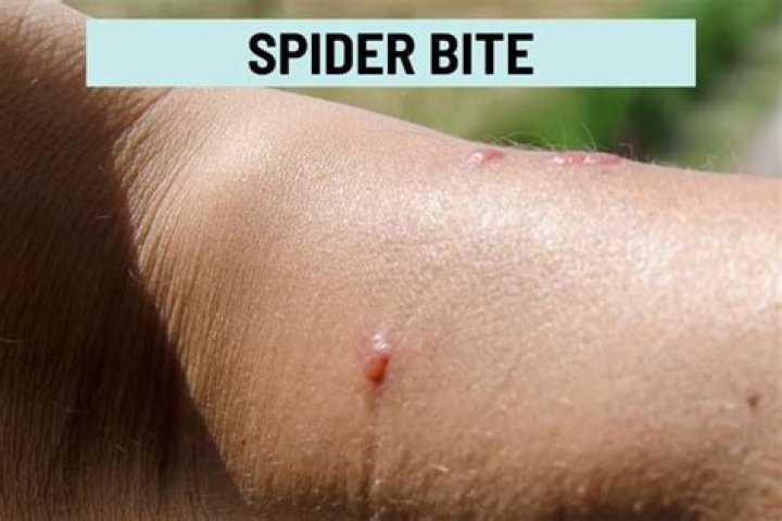 Do spider bites have whiteheads?