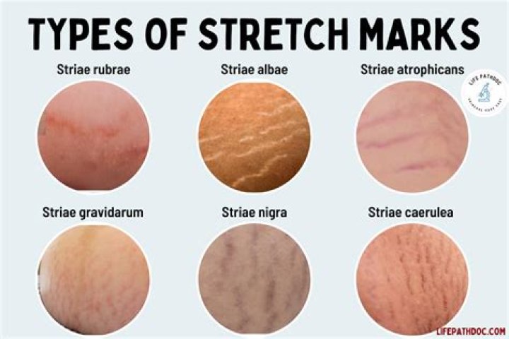 Do teenage stretch marks fade?