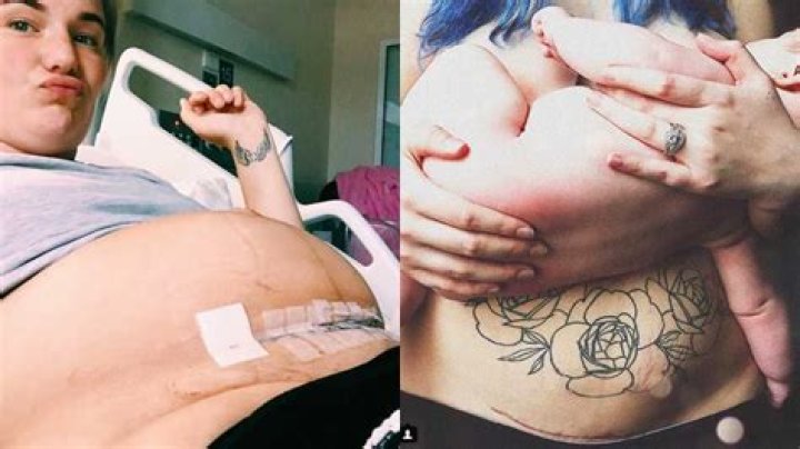 Do they cut the same C-section scar?