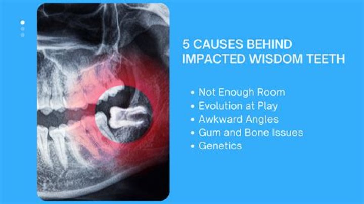 Do wisdom teeth affect health?