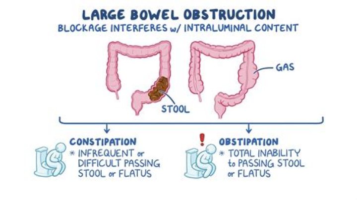 Do you have bowel sounds with an obstruction?
