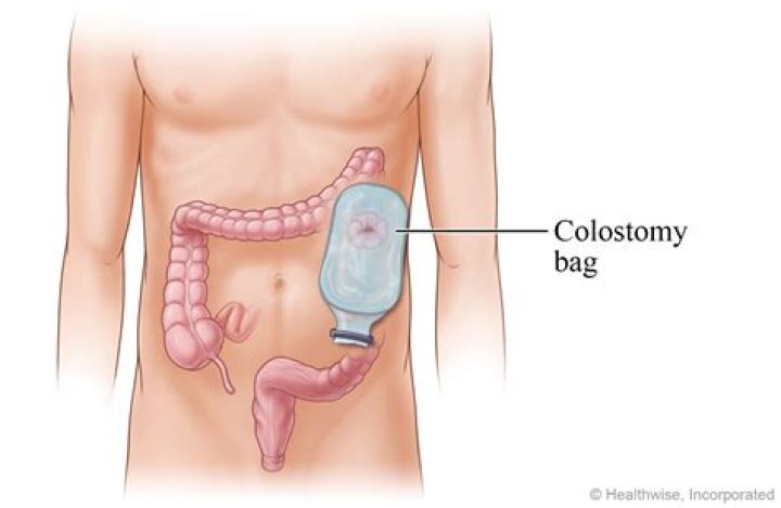 Do you have to have a colostomy bag after colon surgery?