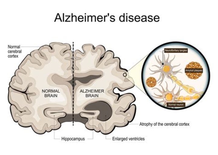 Does a brain MRI show Alzheimer's?