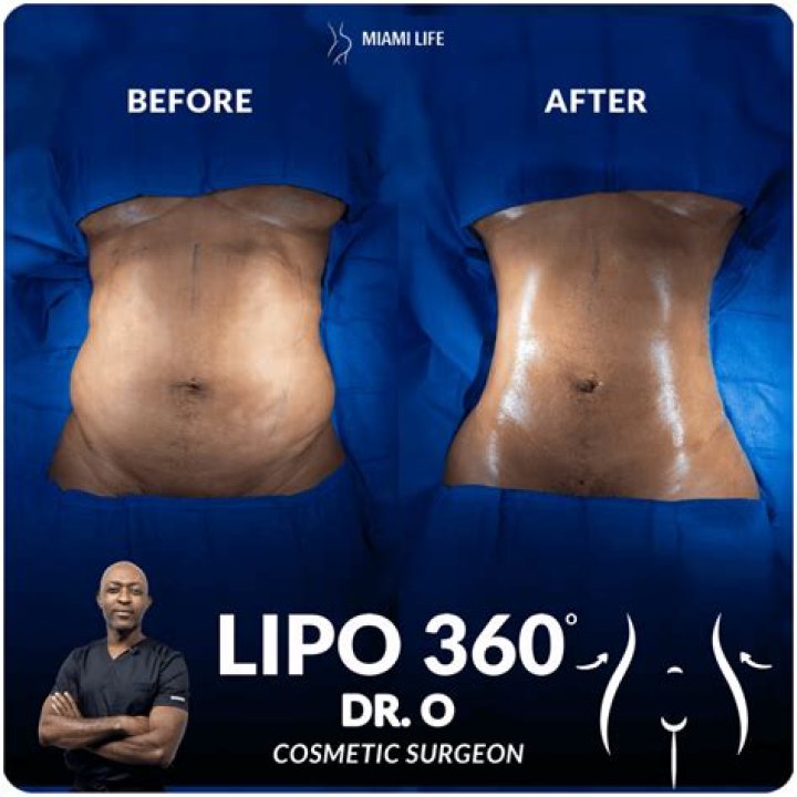 Does a lipo fire need oxygen?