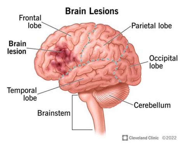 Does a nervous breakdown cause brain damage?
