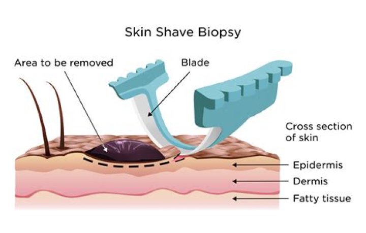 Does a shave biopsy remove the whole mole?