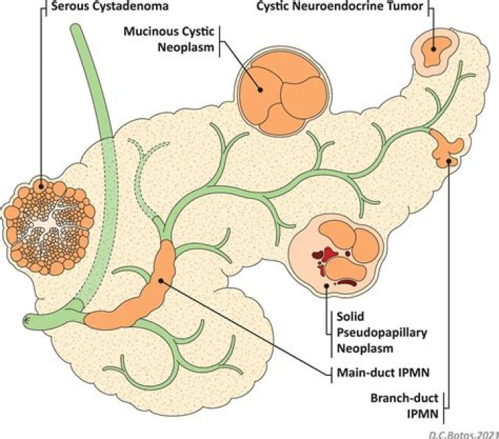 Does a solid mass mean cancer?