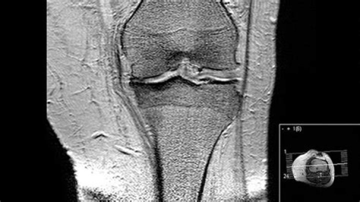 Does arthritis show up on an MRI?