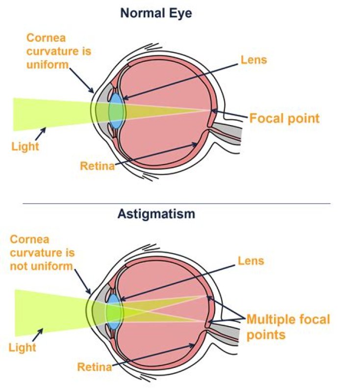 Does astigmatism affect computer use?