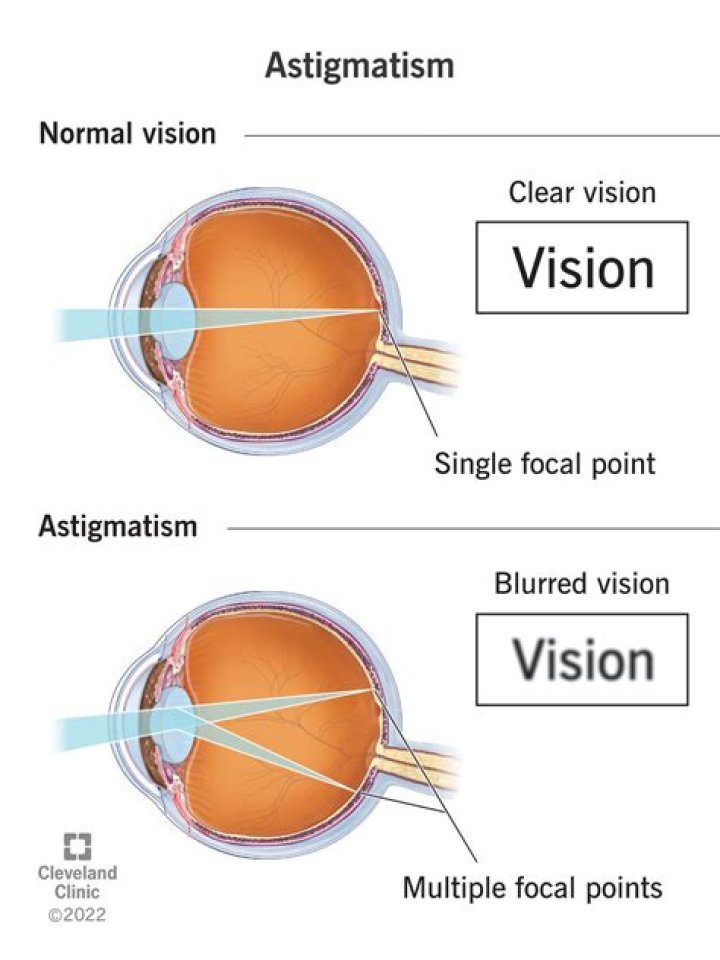 Does astigmatism cause headaches?