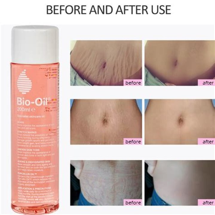 Does Bio-Oil work on old scars?