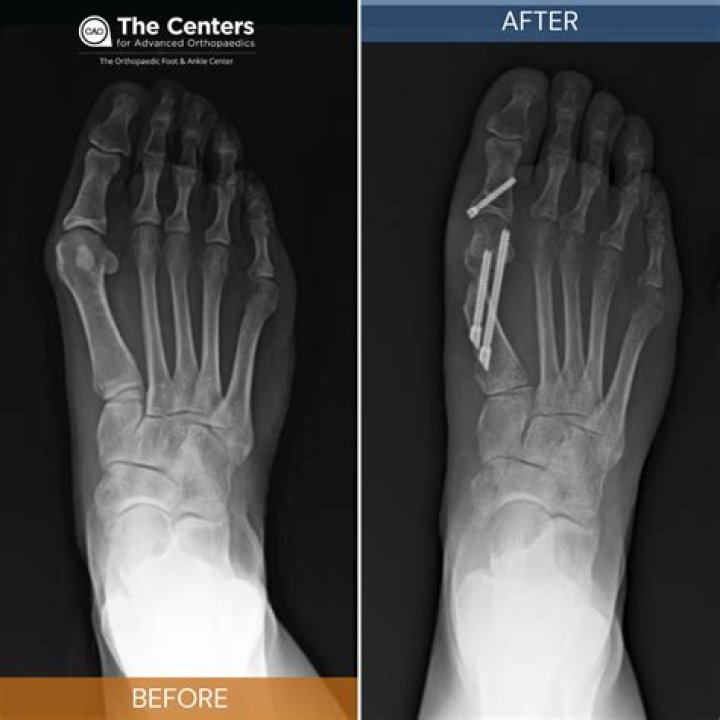 Does bunion surgery require screws?
