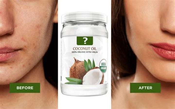 Does coconut oil lighten scars?
