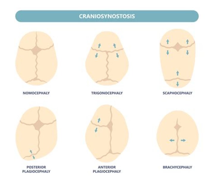 Does craniosynostosis hurt?