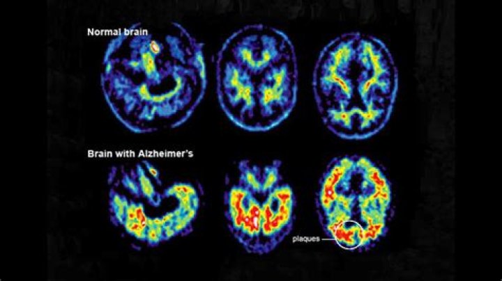 Does dementia always show up on a brain scan?