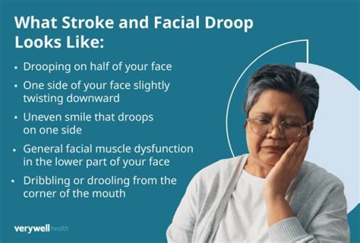 Does droopy face go away after stroke?