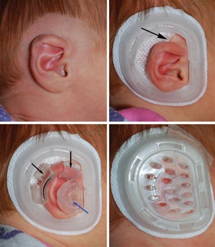 Does ear lidding correct itself?