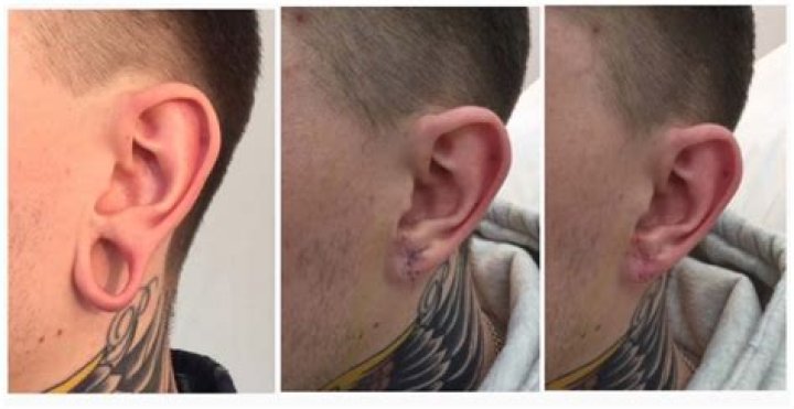 Does ear stretching hurt?