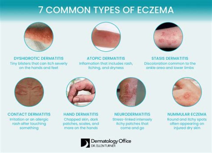 Does exercise help eczema?