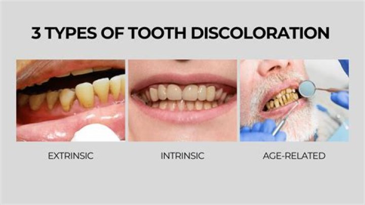 Does fluoride discolor teeth?