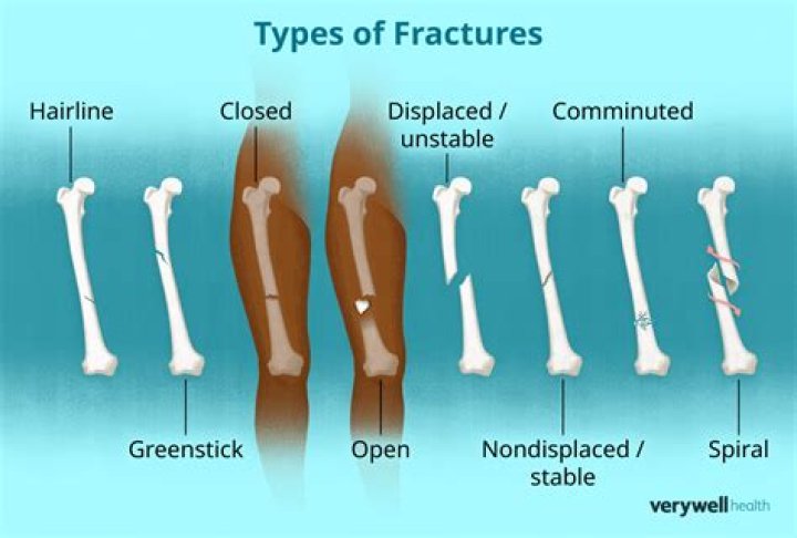 Does fracture Tenrai come back?