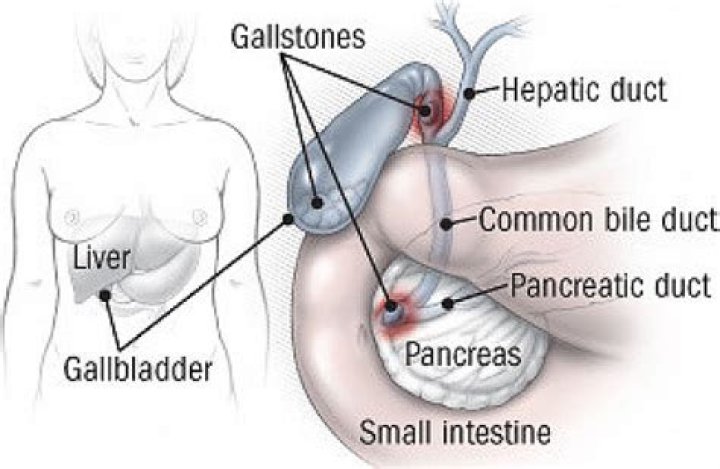 Does gallbladder pain come and go?