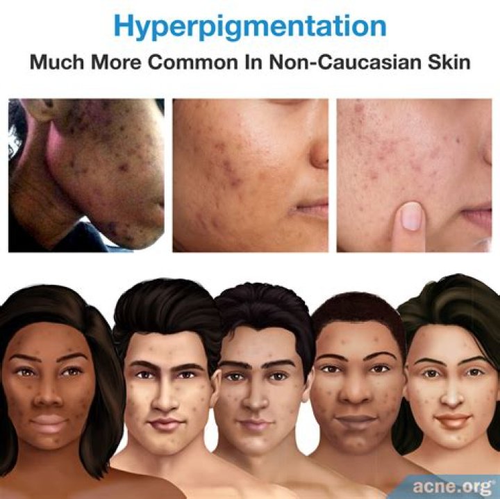 Does heat make hyperpigmentation worse?
