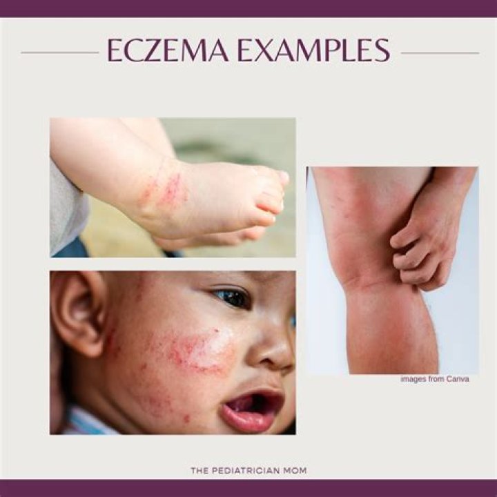 Does ice help eczema?