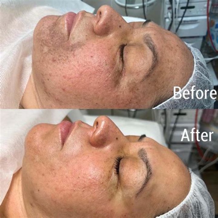 Does kojic acid remove hyperpigmentation?