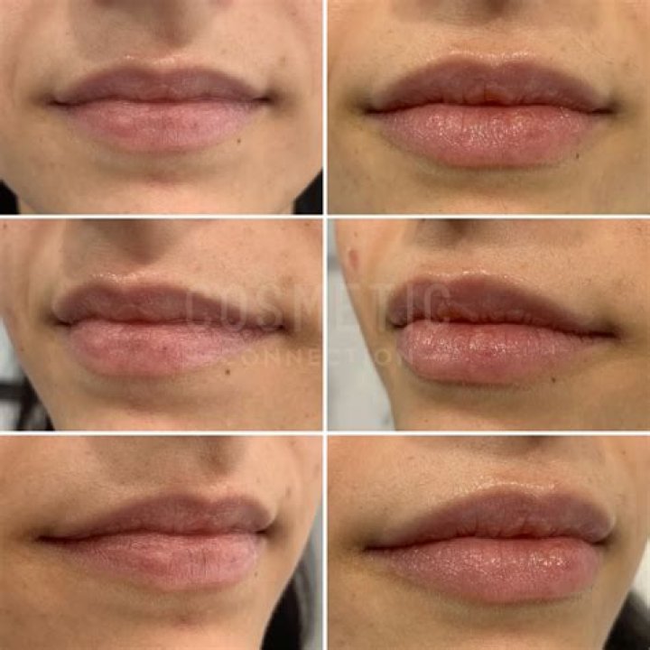 Does lip size change with age?