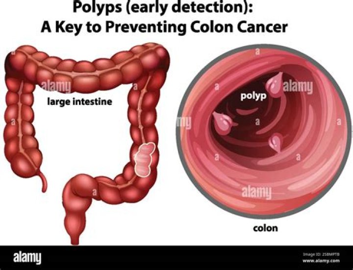 Does location of colon polyps matter?