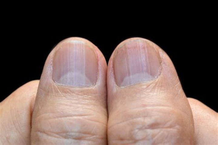 Does magnesium deficiency cause nail ridges?