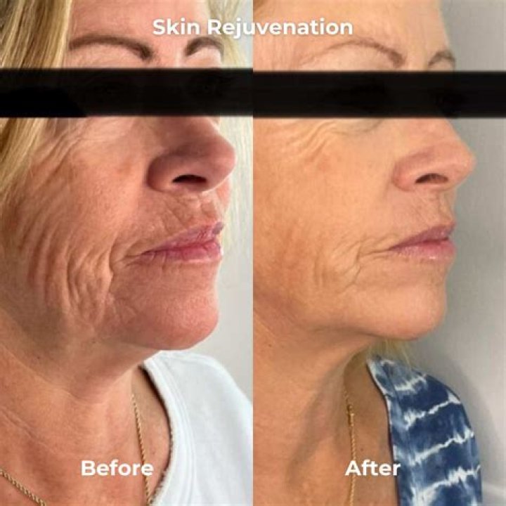 Does microneedling break down scar tissue?