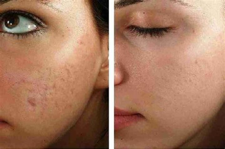Does microneedling fade freckles?
