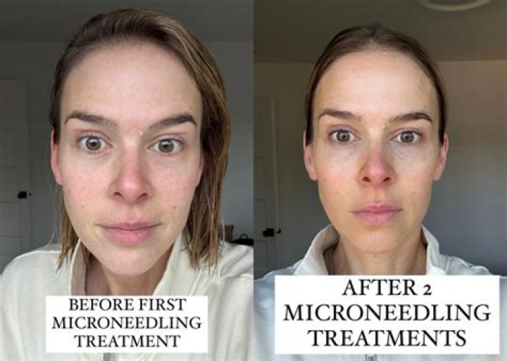 Does microneedling help with marionette lines?