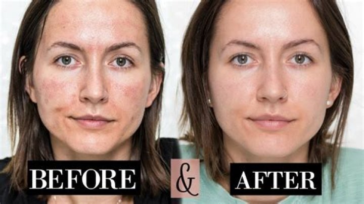 Does microneedling make you look younger?