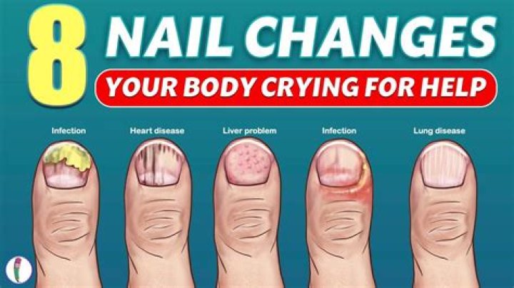 Does neuropathy affect your nails?